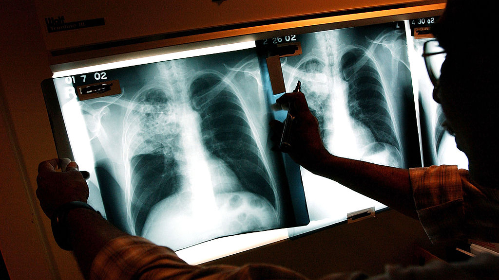 2 active tuberculosis cases traced to San Francisco strip club — KTVU FOX 2 Bay Area, Dublin Health news